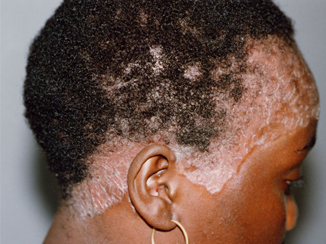 Scalp-Psoriasis-8